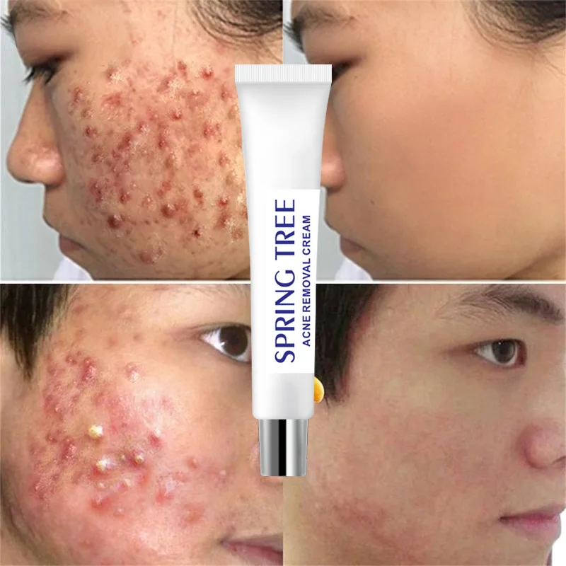 

Acne Removal Cream Herbal Acne Spots Oil Control Acne Cream Skin Care Whitening Moisturizing Face Gel Skin Care 30g