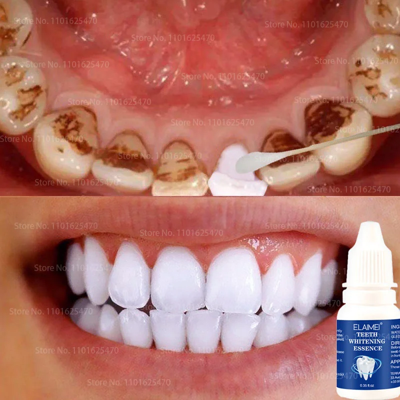 

Teeth Whitening Essence Remove Tartar Calculus Wash Yellow White Lotion Oral Hygiene Cleaning Serum Flawless Tooth