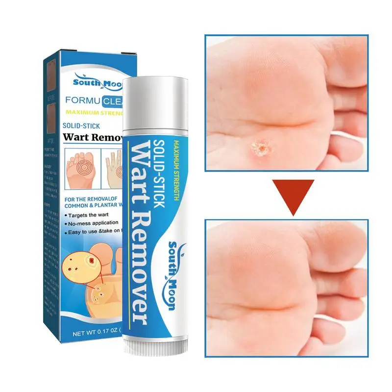 

Solid Cream Painless Removing Warts Papilloma Flat Warts Freckle Plaster Beauty Health Care