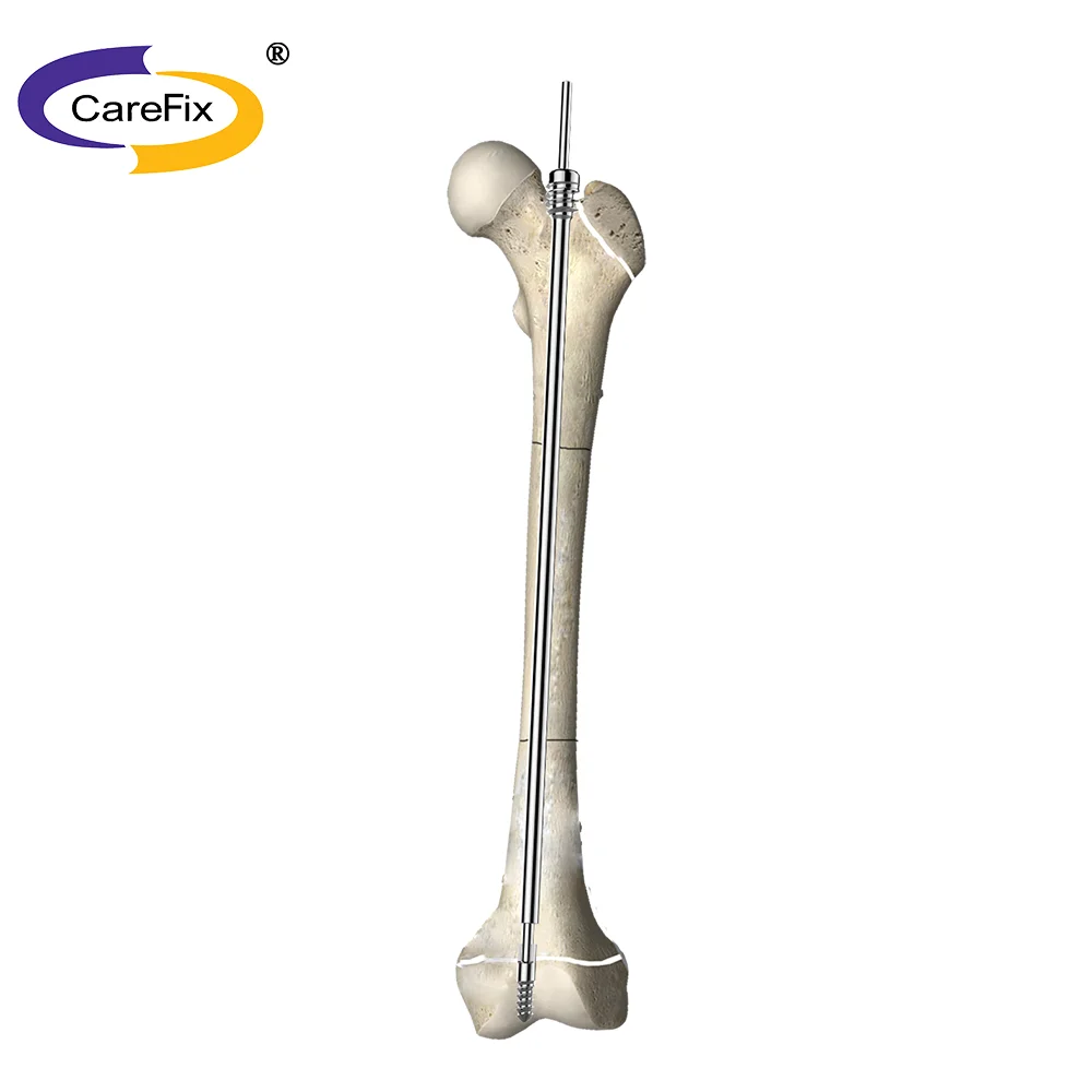 

Orthopedic Implant Femoral Intramedullary Tibia Proximal Femur Interlocking Nail