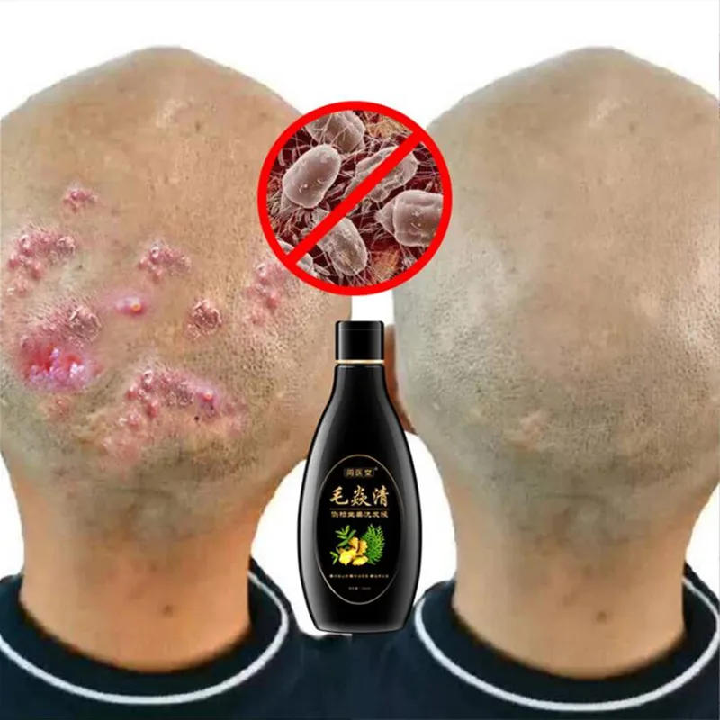 

Scalp Hair Follicle Shampoo Antibacterial Anti-itching Mites Oil Control Psoriasis and Scalp Cleansing Shampoo Skincare Product