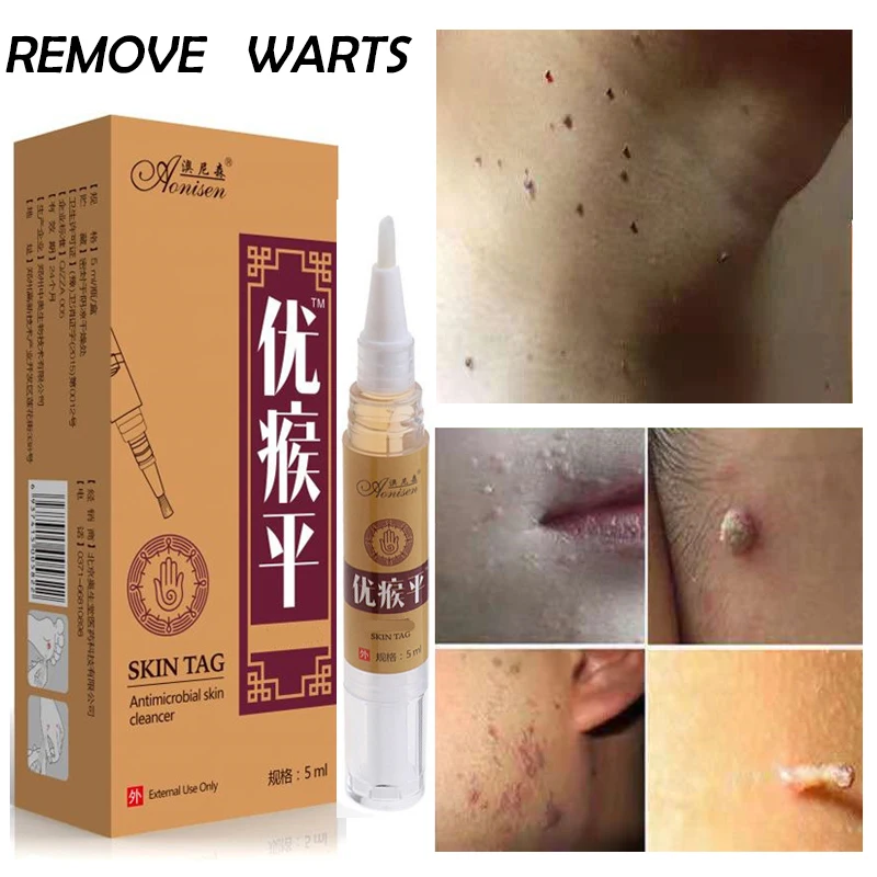 

1pc 5ml Skin Tag Remover Medical against Moles 12 Hour Fast Wart Removal Acne Spot Treatment Anti Foot Corn Lotion free shipping