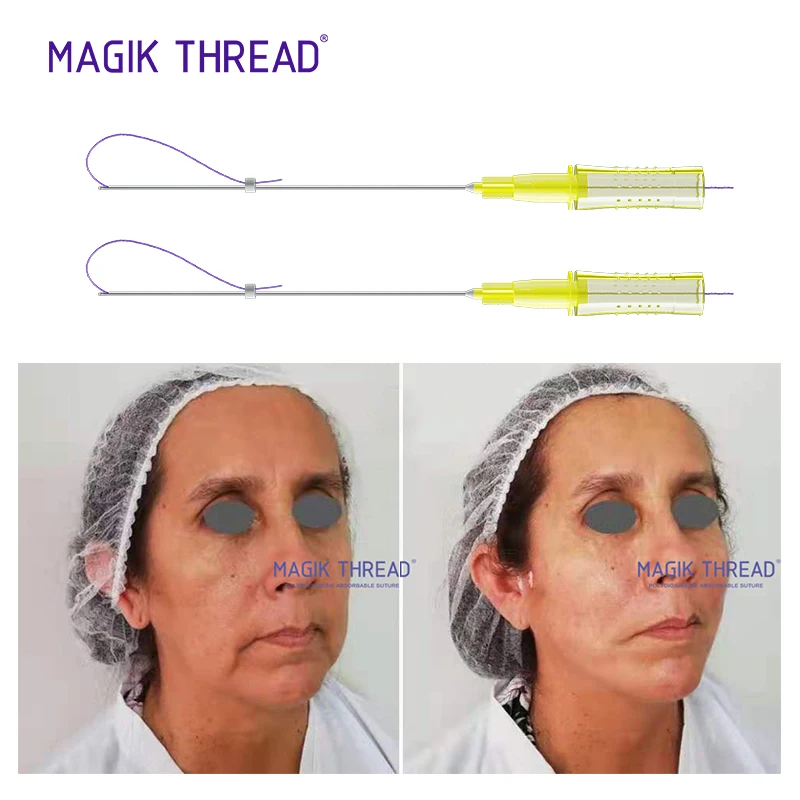 

Pdo Thread Manufacture Mono Screw Cog Thread Lifting Face V-Line High Quality Facial Pdo Wires Beauty Salon Use