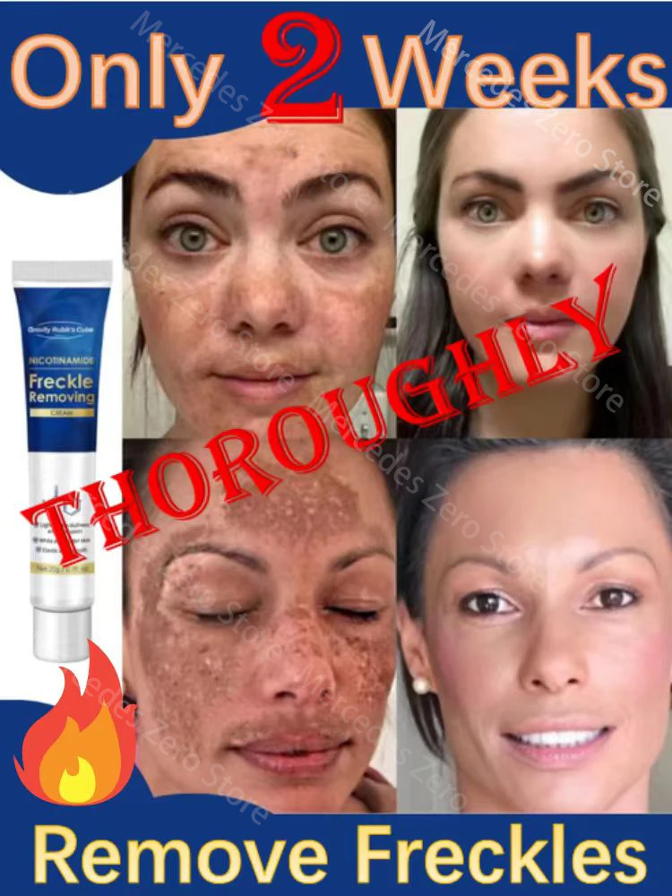 

Dark Spot Remover for Face Removing Freckle Chloasma Senile Plaques Sunburn Cyasma Chorioplaque Freckle Cream Light Dark Spots