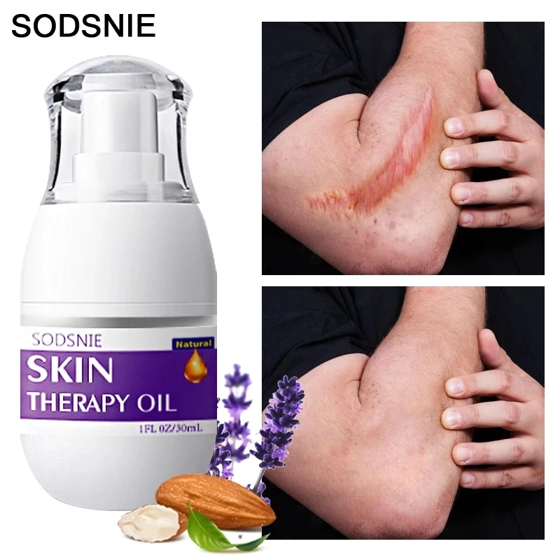 

30ml Natural Skin Therapy Oil Eliminates Stretch Marks and Scars Repairs Aging Damaged Skin Whitening Moisturizing Body Care