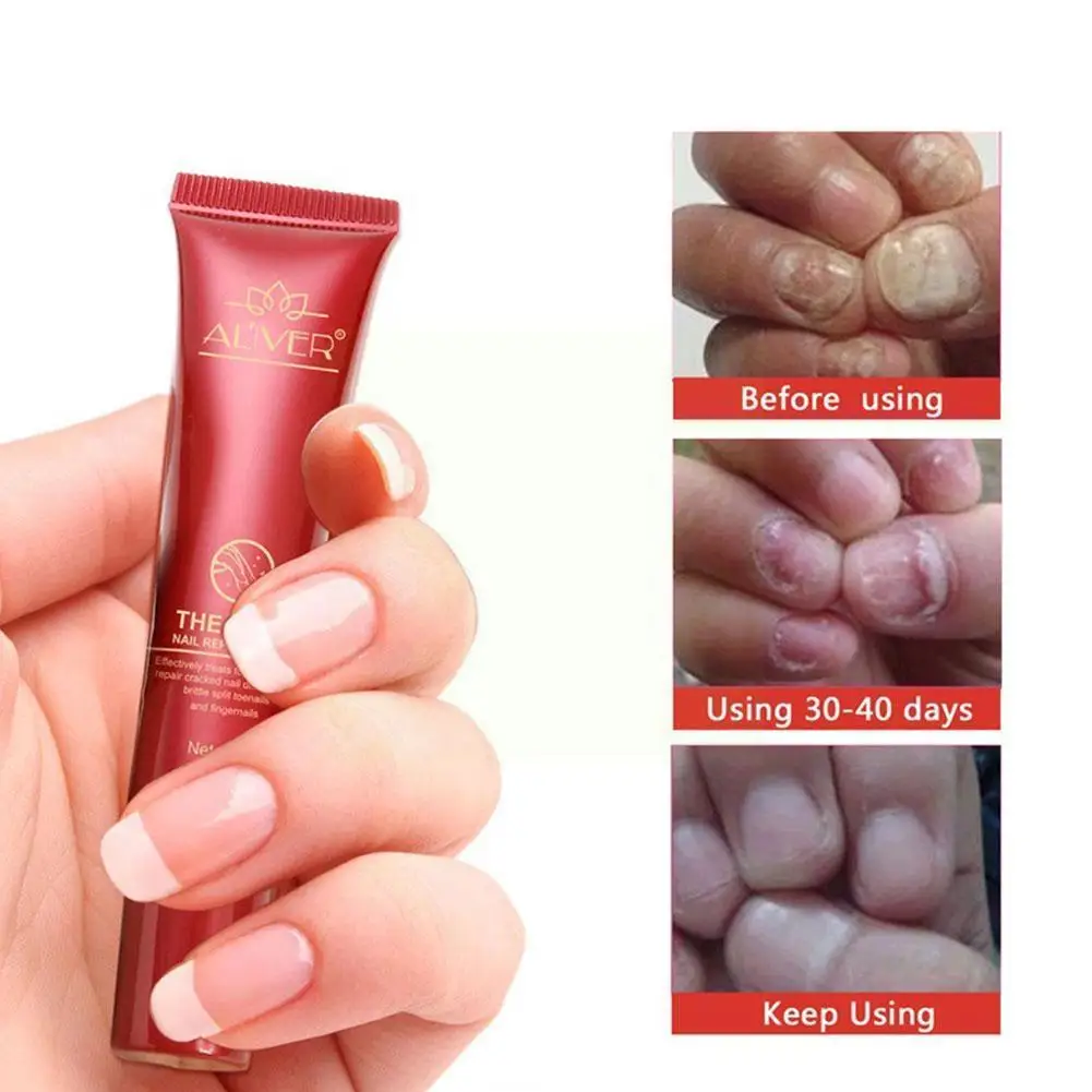 

15ml Aliver Nail Fungus Treatment Herb Nails Repair Protector Care Tools Cream Cream Care Nail Onychomycosisnail Skin V2p2