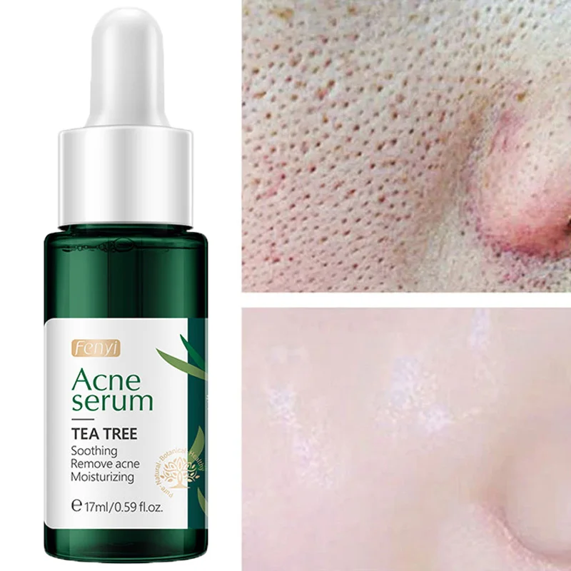 Tea Tree Facial Acne Removal Serum Treatment Acne Scar Spots Pimple Whitening Shrink Pores Oil Control Anti-Acne Fade Skin Care