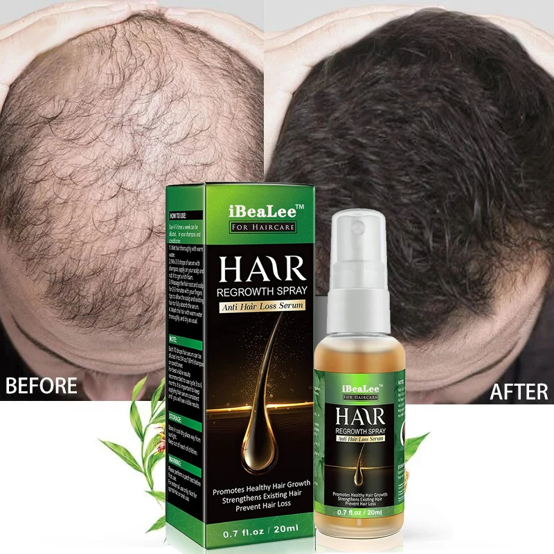 Ginger Hair Growth Spray Scalp Hair Loss Treatment Baldness Remedy Germinal Oil Hair Follicle Growth Anti Alopecia Beauty Care
