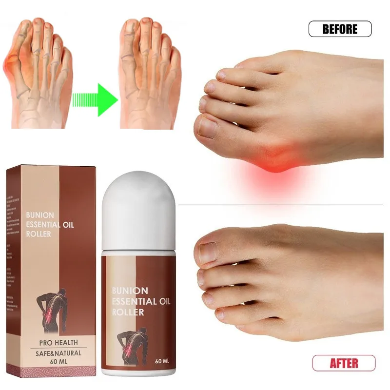 

60ml Bunion Oil Roller Correction Thumb Valgus Pain Relief Foot Care Massage Oil Roller Relief Foot Pain Foot Care Pain Relief