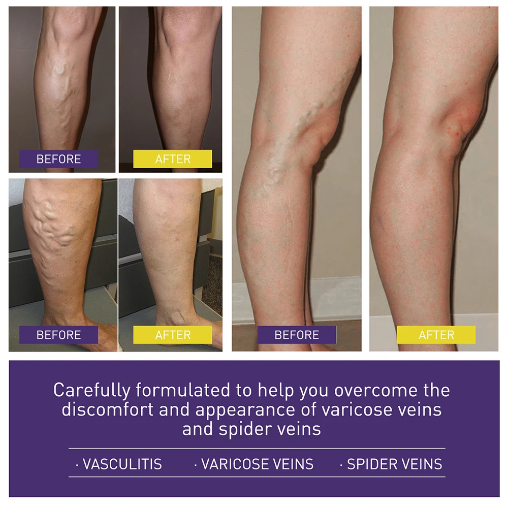 

Varicose Vein Paste Relieve Vasculitis Pain Paste Herbal Plaster Repair Earthworm Legs Relieve Leg Swelling Pain Beauty Care New
