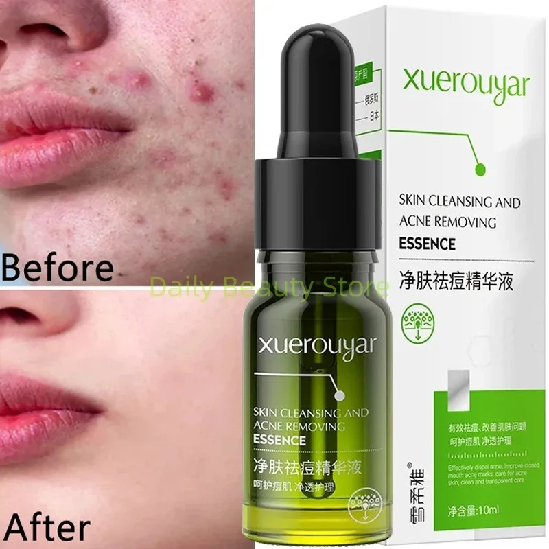 Сыворотка для удаления прыщей с салициловой кислотой восстанавливает кожу