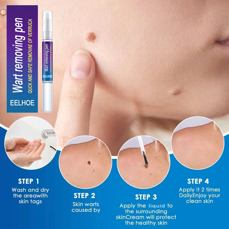 

Skin Tag Warts Remover Cream Herbal Antibacterial Ointment Wart Treatment Cream Anti Foot Corn Papillomas Herbal Removal Gel