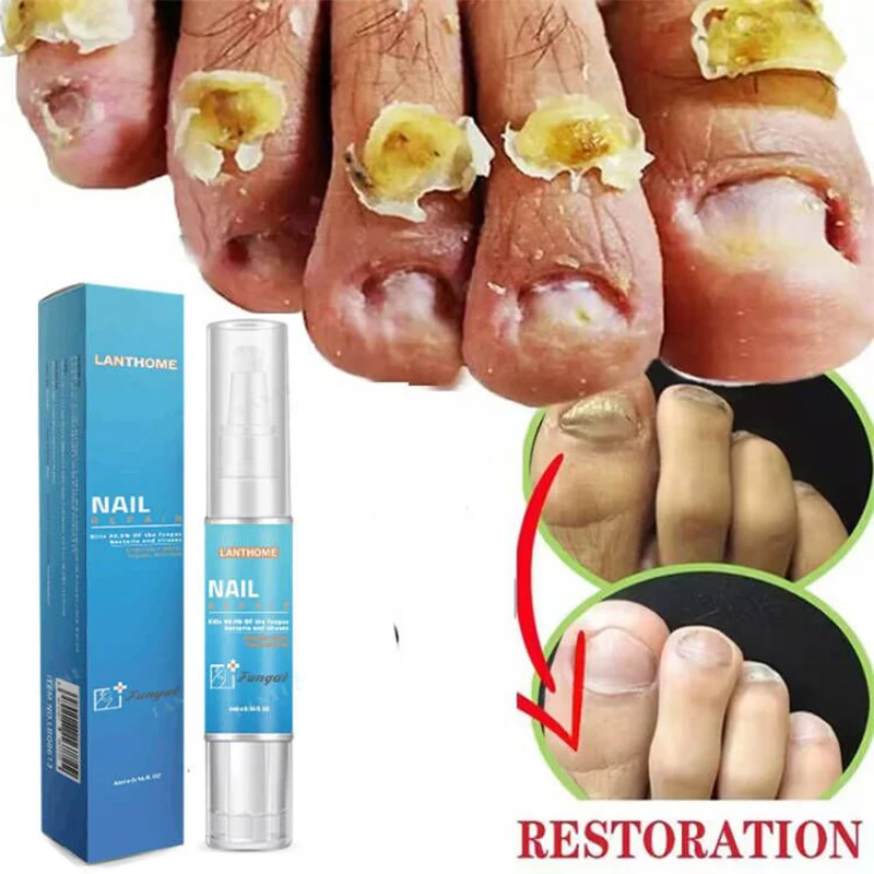 

Сыворотка для лечения Ногтей от грибков, онихомикоз, паронихия, анти-инфекция, удаление грибка на пальцах ногтей, восстанавливающий гель, инструмент для красоты и здоровья ногтей