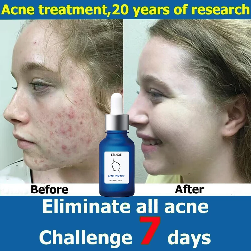 

7days Acne Remove Face Serum Treatment Pimples Scars Hyaluronic Acid Shrink Pores Control Oil Blackheads Essence Skin Care 30ml