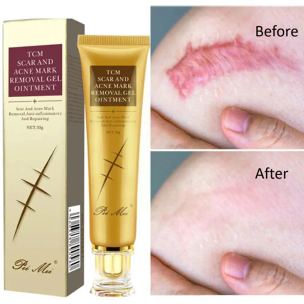 

30g Acne Scar Removal Cream Gel Face Pimples Stretch Whitening Smoothing Care Moisturizing Repairing Cream Marks Cream Body R2M1