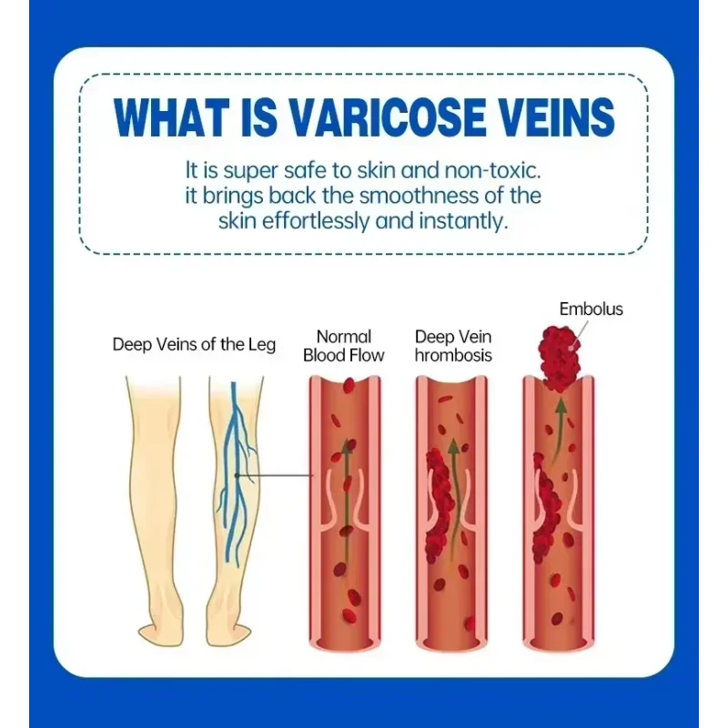 Laser treatment of varicose veins in spider leg vasculitis with anti vascular swelling and pain relief cream