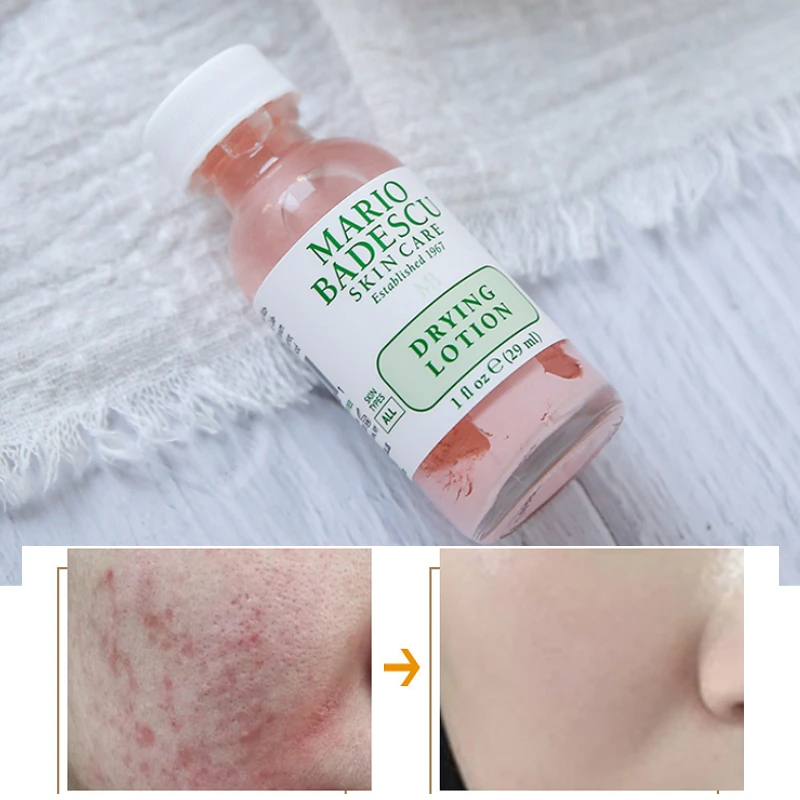 

29ml An Effective Acne Treatment Original Mario Badescu Drying Lotion Anti Acne Serum Pimple Blemish Removal Skin Care