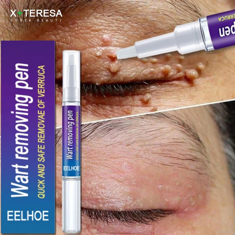 

3PCS Wart Remover Liquid Antibacterial Ointment Wart Treatment Cream Skin Tag Remover Herbal Extract Corn Plaster Warts Ointment