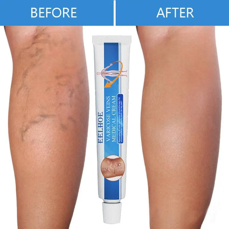 

EELHOE Varicose Veins Relief Cream Herbal Treatment Vasculitis Phlebitis Spider Pain Relief Ointment Medical Plaster Body Care