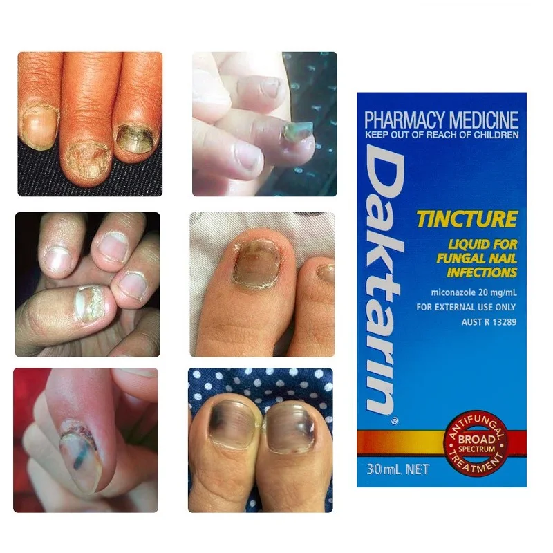 

Тонирующий раствор австралийского дактарина для лечения грибковых инфекций ногтей, антигрибковое защитное покрытие широкого спектра