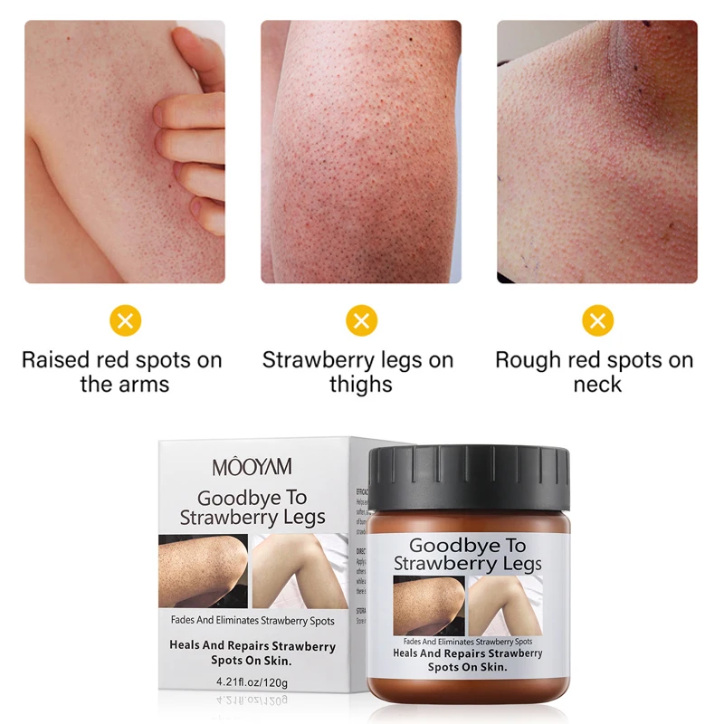 

Goosebump removal exfoliating pimples smooth and rejuvenating skin moisturizing lotion, body cream, goosebump removal, leg cream