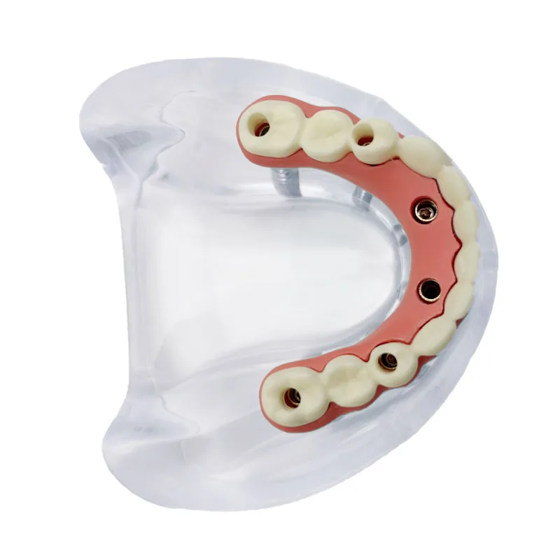 1 шт. модель зубного имплантата 6 имплантатов реставрация зубов стоматолог