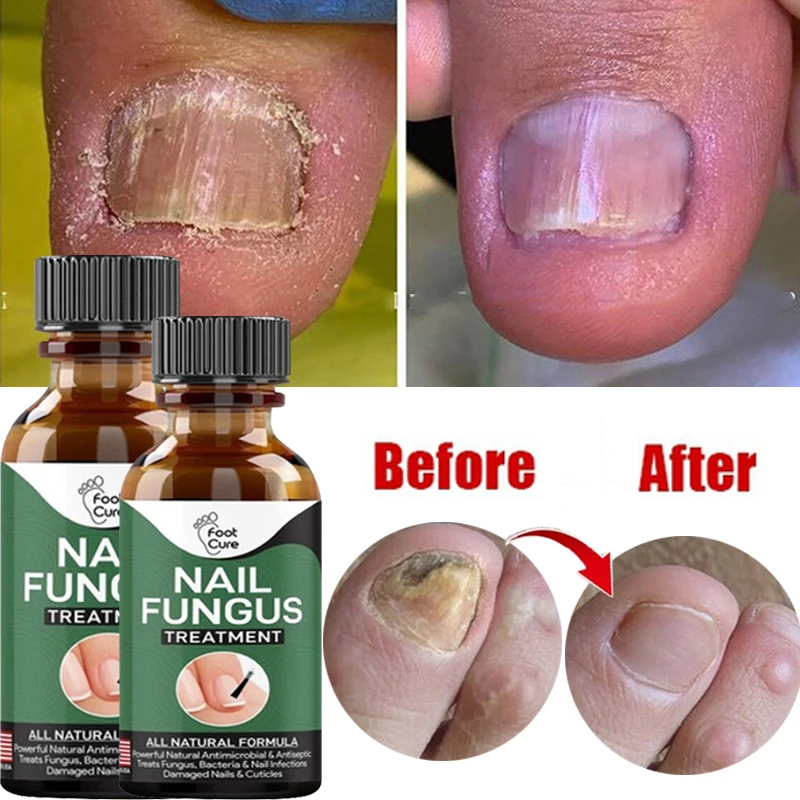 

Средство для лечения Ногтей от грибков, эссенция для ухода за ногтями, антиинфекционная Сыворотка для удаления грибка паронихии и онихомик...