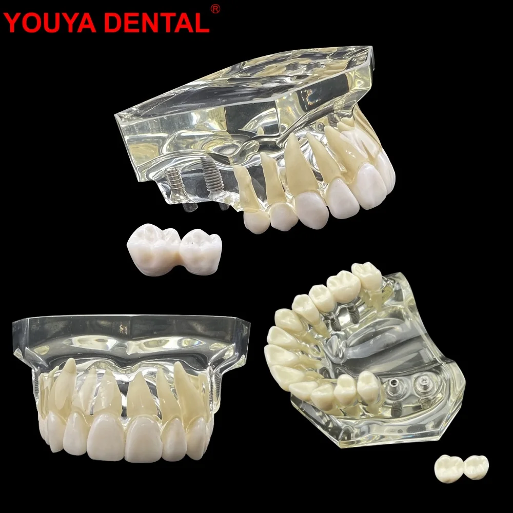 4 имплантата модель для челюстных зубов новая коррекции со съемными зубами