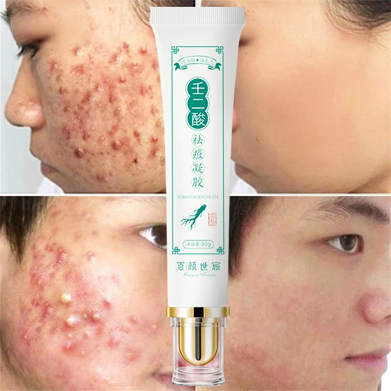 

Azelaic Acid Acne Removal Cream Treatment Acne Scar Shrink Fade Acne Spots Pores Oil Control Whitening Moisturizing Face Skin