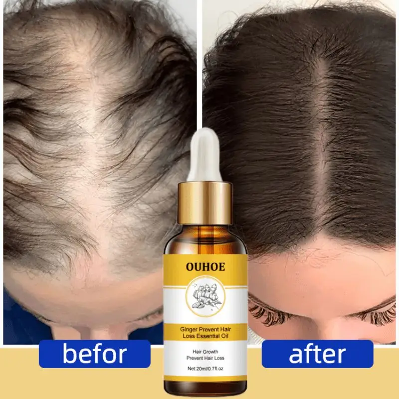 

Powerful Hair Serum Growth Anti Hair Loss Fast Hair Growth Seborrheic Alopecia Hairline Up Hair Follicle Treatment Healthy Care