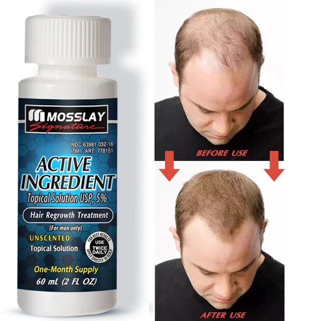 Mosslay 60 ml Hair Growth Essential Oil, Anti-hair Loss, Repair Hair Follicles, Activate Hair Roots, Restore Thick Hair 1