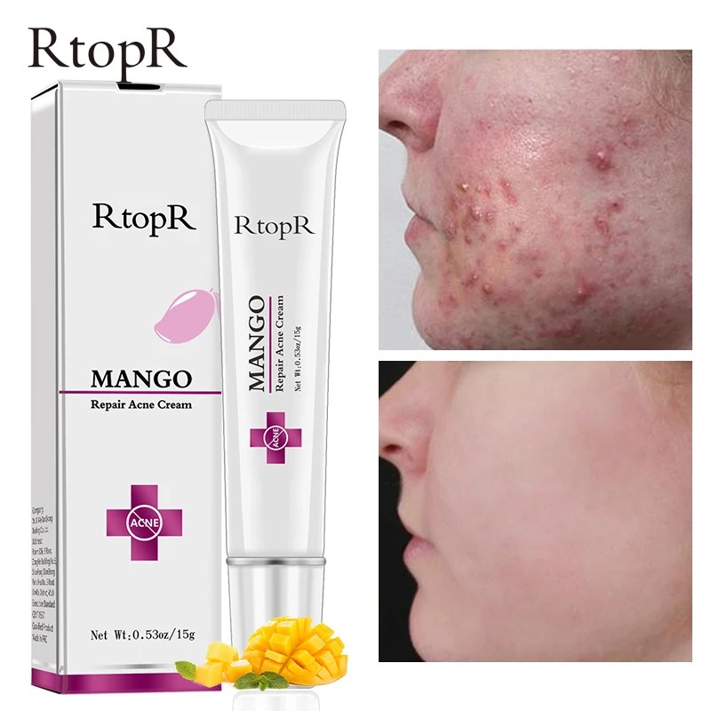 Mango Acne Cream Anti-Acne Treatment Acne Scar Removal Cream Dark Spot Whitening Anti Aging Face Cream Moisturizing Skin Care