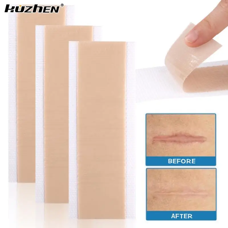

Silicone Surgical Scar Removal Patch Remove Trauma Burn Sheet Skin Repair Scar Removal Therapy Patch For Acne Scar Treatment