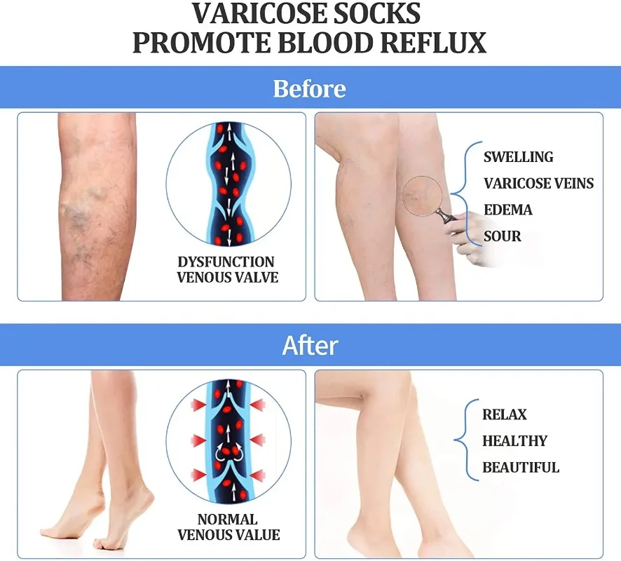 Колготки компрессионные женские с градиентом 20-30 мм рт. Ст.
