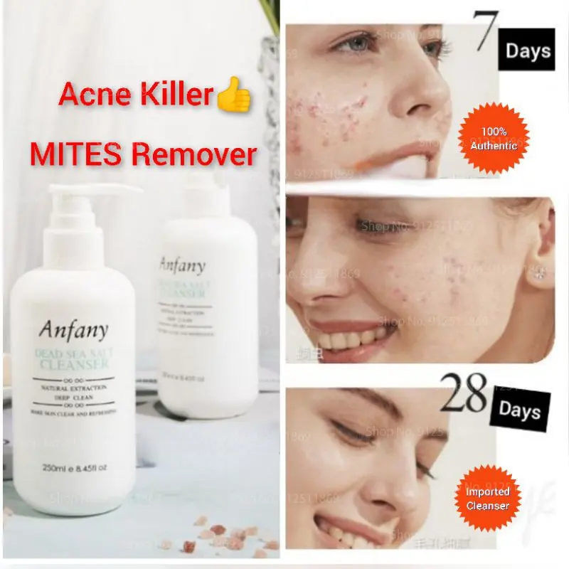 

Anti Pimples Acne Scars Mite Removal Facial Cleanser Oily Control Pembersih Gel Cream Jerawat Muka 여드름 및 진드기 제거 클렌징