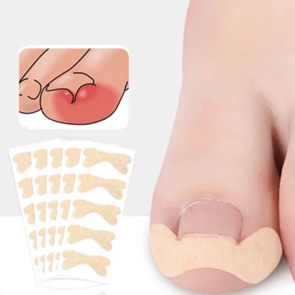 

6pcs/sheet Nail Correction Stickers Ingrown Toenail Corrector Patches Paronychia Treatment Recover Corrector Pedicure Tools