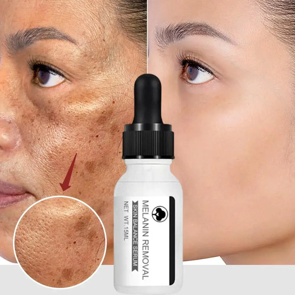 

Niacinamide Dark Spots Remover Serum Freckle Whitening Powerful Removal Black Dot Melasma Chloasma Face Skin Care Essence