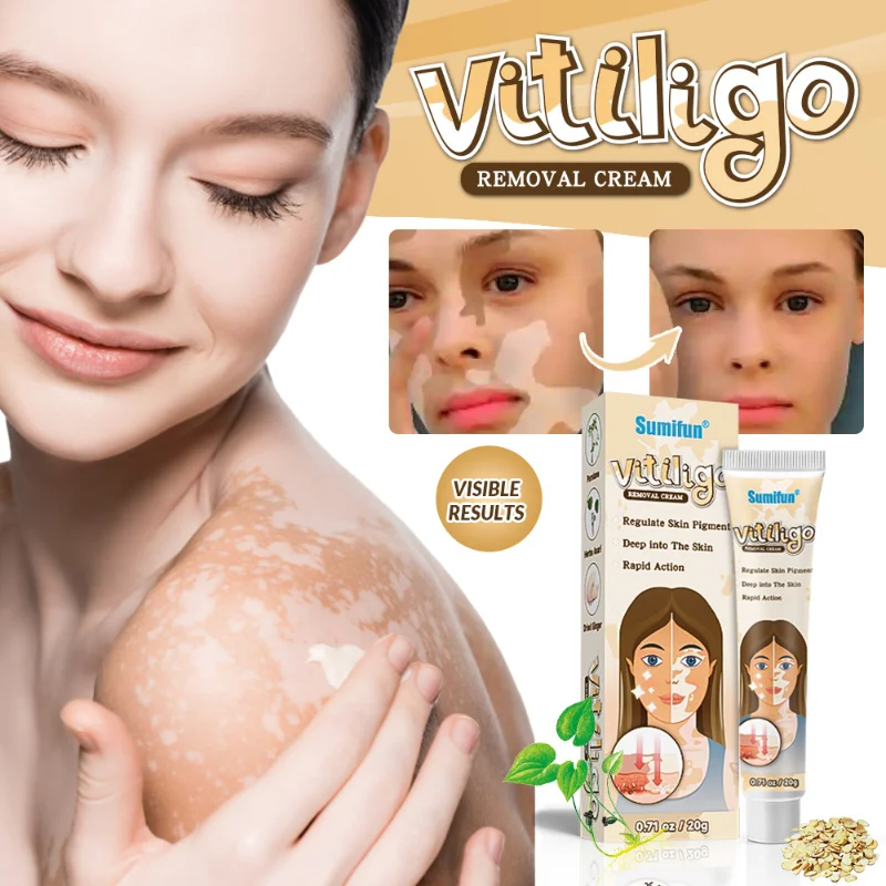 

Крем Vitiligo для уменьшения белых пятен, отложения меланина, восстановление кожи, леоплакия, лечение заболеваний, снятие зуда кожи, травяная мазь, уход за кожей 20 г