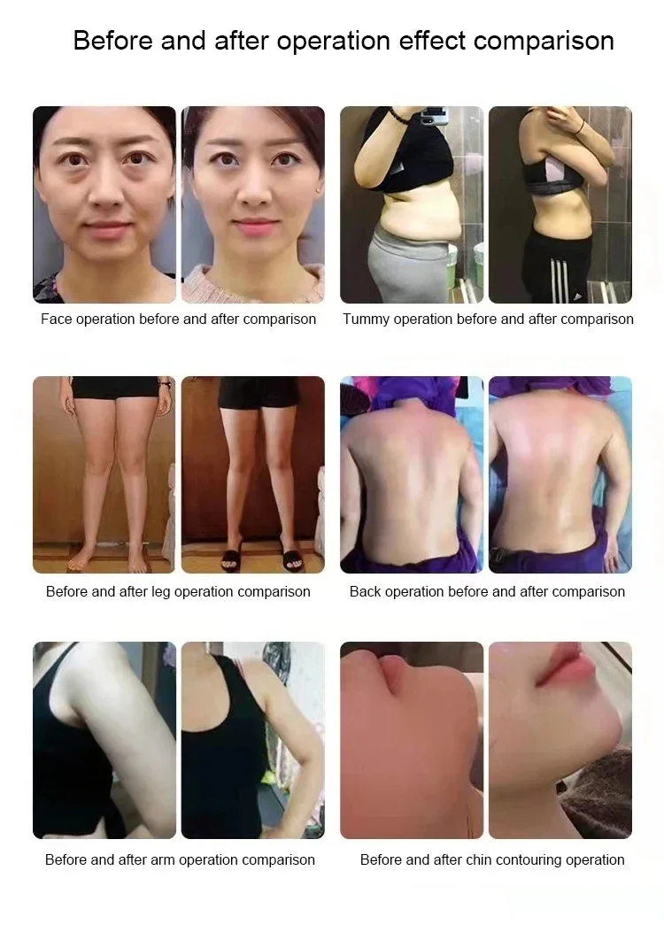 Аппарат для физиотерапии Ret Tecar 448 кГц Indiba высокочастотное устройство портативное