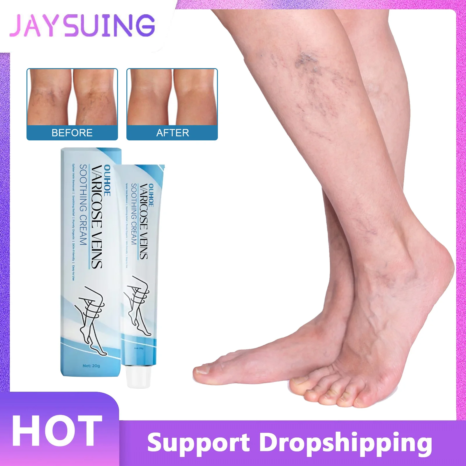 

Varicose Veins Relief Treatment Cream Effective Relieve Legs Dilated Vasculitis Phlebitis Spider Pain Soothing Leg Ointment 20g