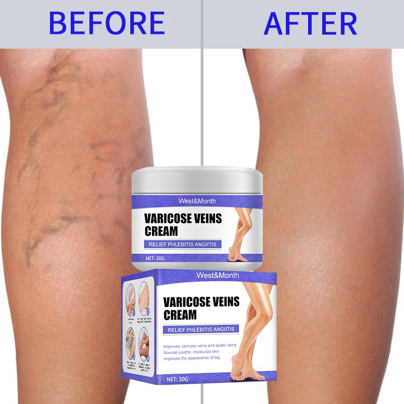 Effective Varicose Veins Relief Cream Relieve Vasculitis Phlebitis Spider Pain Treatment Ointment Medical Plaster Body Care 30g