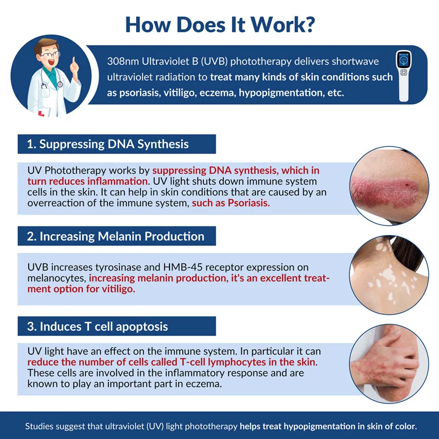 ZJKC 308nm Экксимерная система Фотодинамическая терапия УФ-световое устройство для