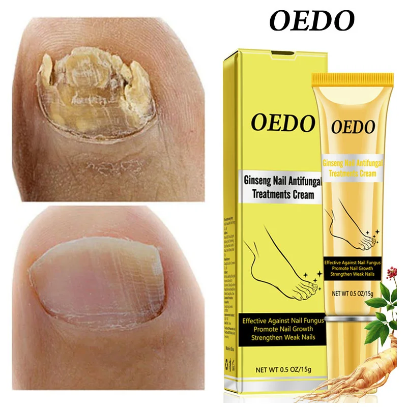 

Ginseng Nail Fungus Treatment Cream Anti Infective Remove Onychomycosis Paronychia Toe Repair Damaged Nail Bed Nourish Foot Care