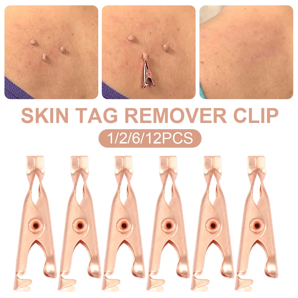 

1/2/6/12Pcs Skin Tag Remover Clip Painless Mole Wart Skin Tags Removal Clips Body Warts Treatment Beauty Tools