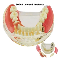 dental implant teeth model m6006 typodont overdenture 3 implants bridge inferior lower restoration treatment demo study teach