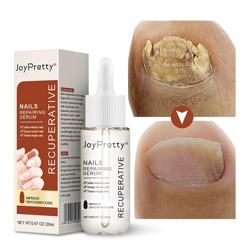 

JoyPretty Nail Fungal Treatment Serum Nail Foot Onychomycosis Paronychia Anti-Fungal Toe Fungus Removal Gel Essence Feet Care