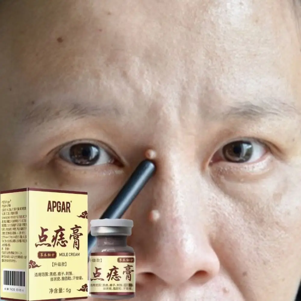 

Skin Care Mole Remover Painless Wart Remover Effective Face Body Tag Remover for All Skin Types