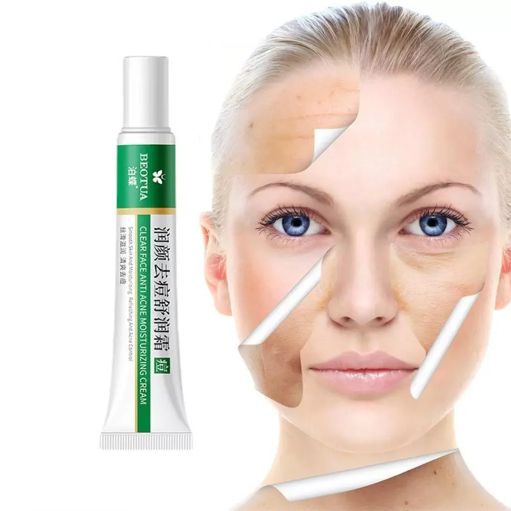 

Acne Removal Cream Herbal Acne Spots Oil Control Acne Cream Skin Care Whitening Moisturizing Face Gel Skin Care 20g