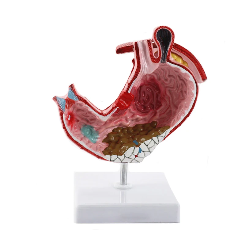 

Human Anatomical Stomach Model Medical Anatomy Model Gastric Pathology Gastritis Ulcer Medical Teaching Learning Tool