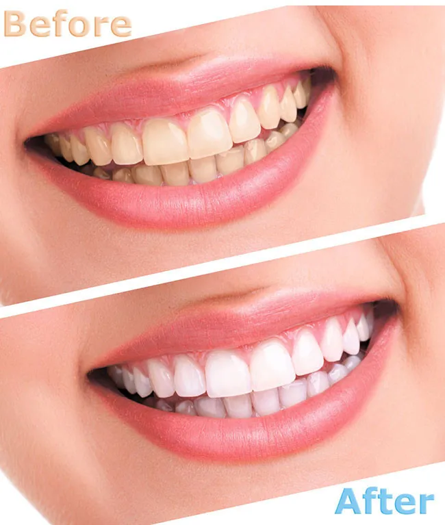 5 pcs 3ml Teeth Whitening gels wholesale 44% Peroxide Dental Bleaching System Oral Gel Kit  teeth whitening pen wholesale images - 6